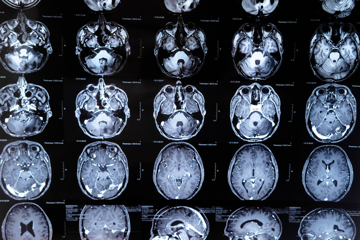 Brain aging may start long before cells are lost